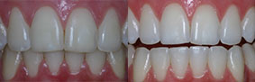 Clareamento dental CASO 1