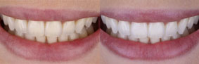 Clareamento dental CASO 2