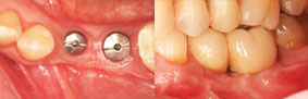 reabilitação implante múltiplos dentes CASO 1